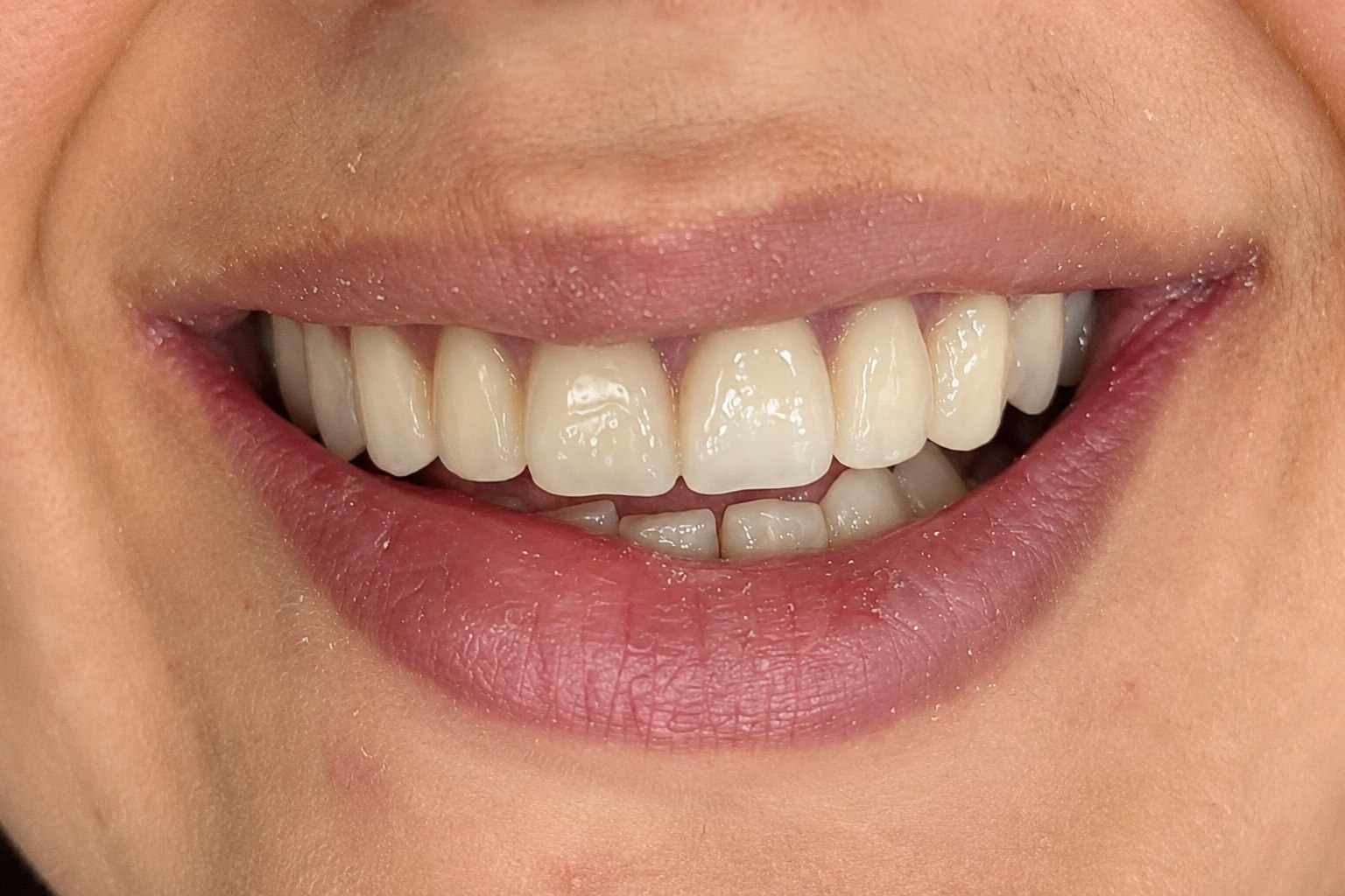 Résultat après traitement esthétique et dentaire - Luxury Smile Rouiba