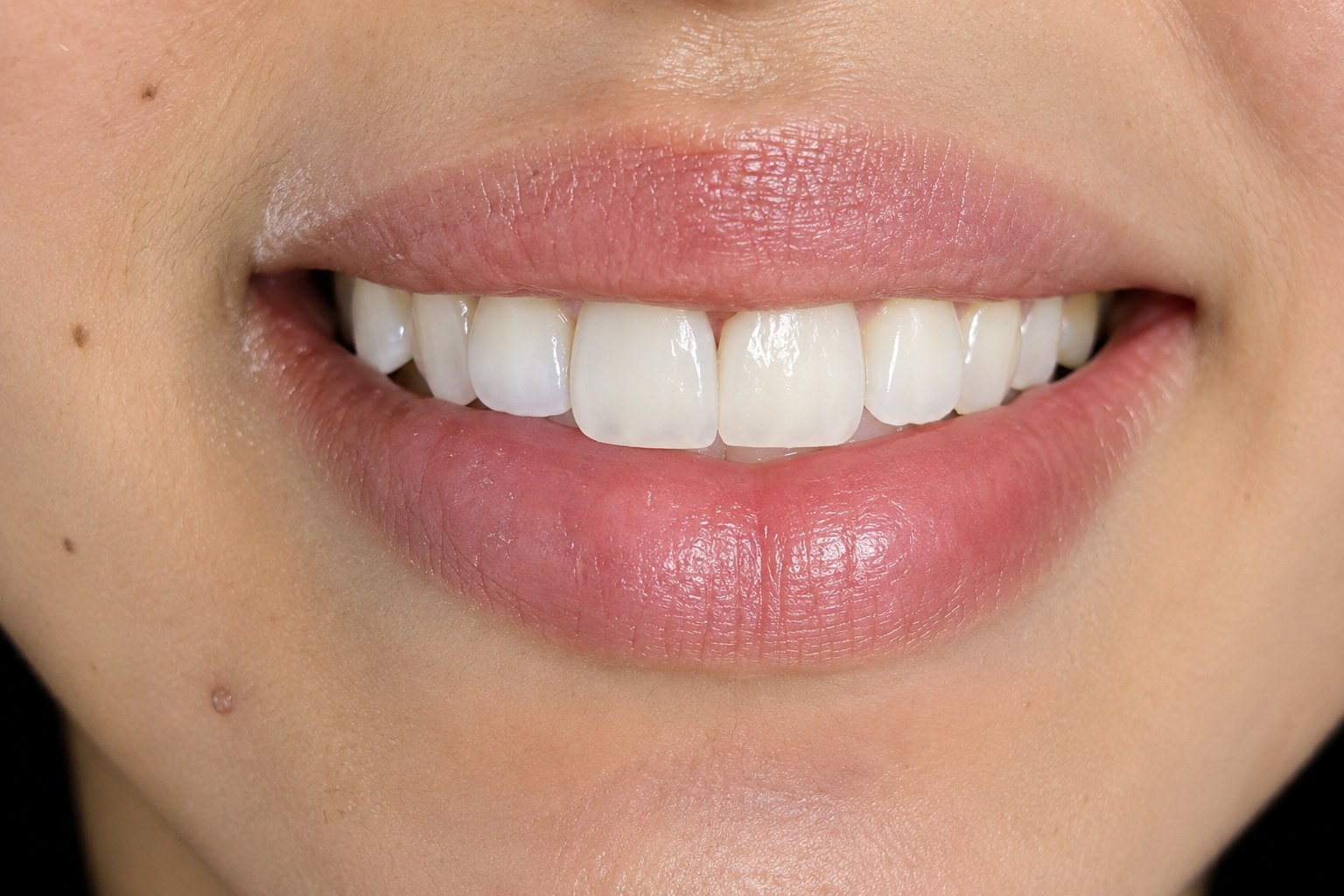 Résultat après traitement esthétique et dentaire - Luxury Smile Rouiba